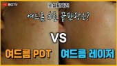 여드름치료의 모든것 여드름 PDT VS 레이저치료 비교